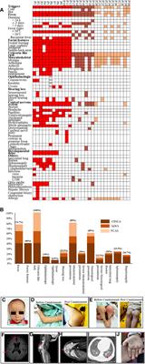 The genetic and clinical characteristics and effects of Canakinumab on cryopyrin-associated periodic syndrome: a large pediatric cohort study from China